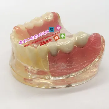 האדם המודל שיניים מודל מקיף פתולוגיה להסרה שתל תיקון קריסטל משלוח חינם